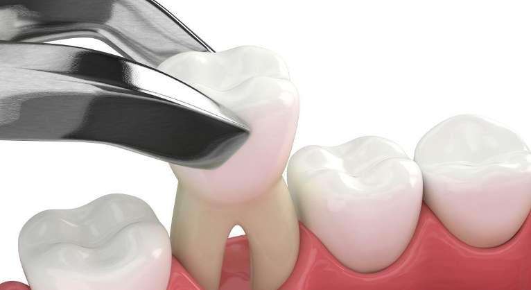 tooth being pulled out
