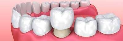 dental crowns illustration in Camas, WA