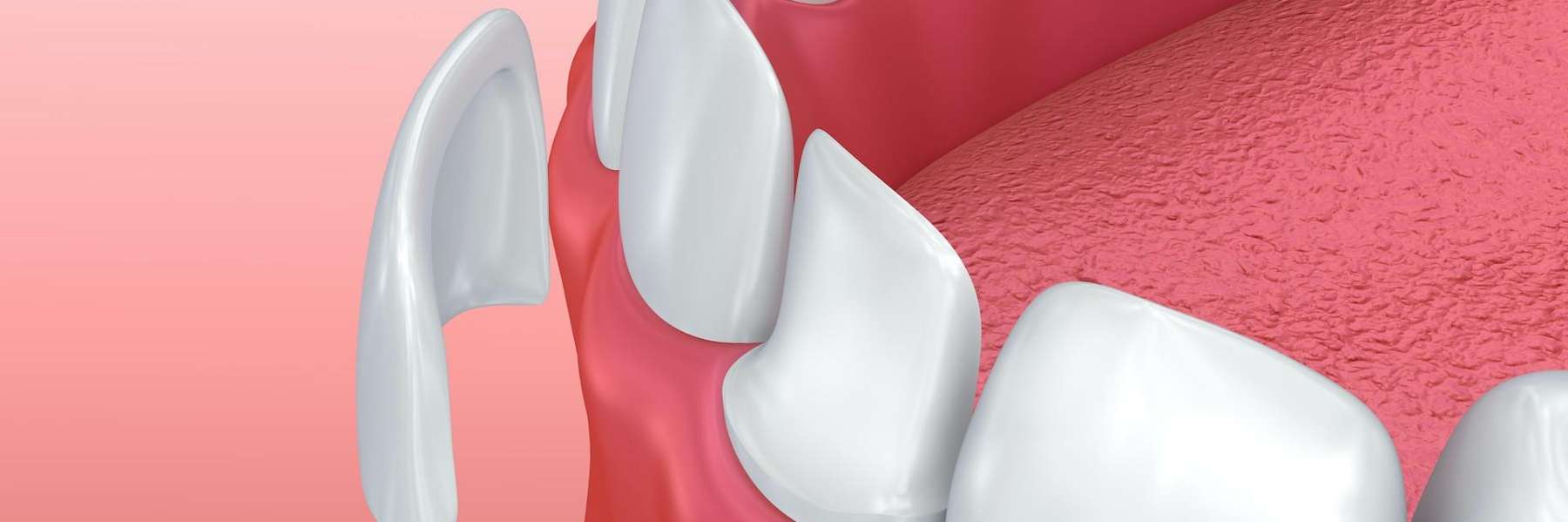 3D illustration of dental veneer placement on a tooth