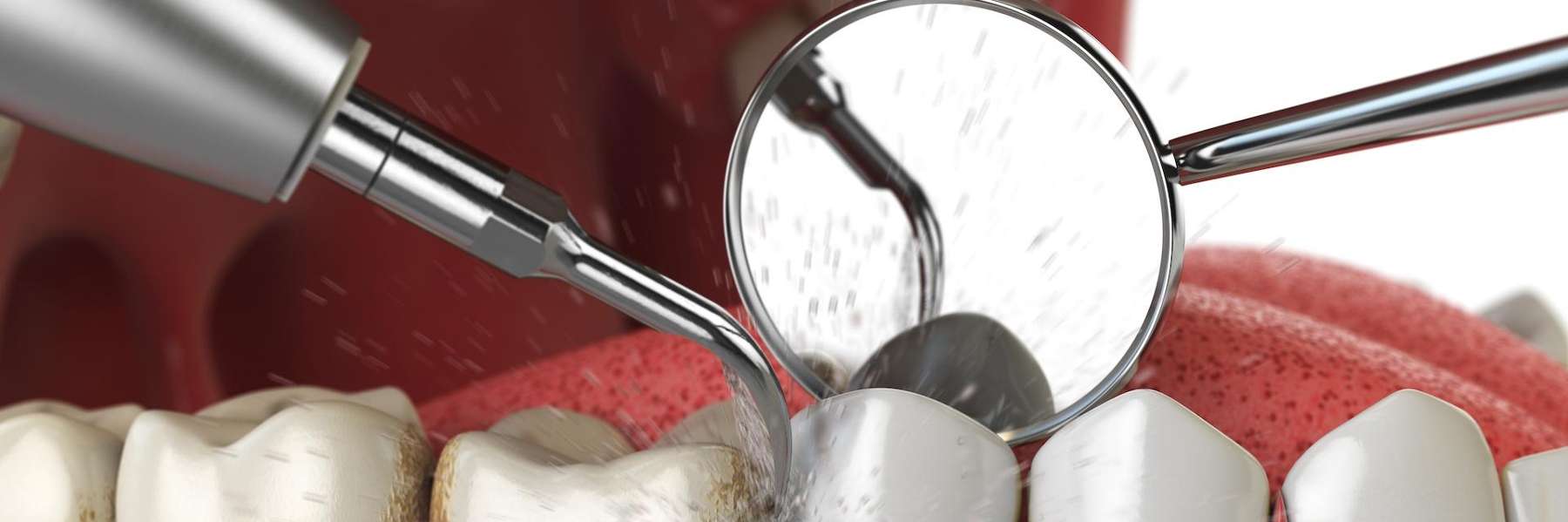 dental cleanings for long-term oral health